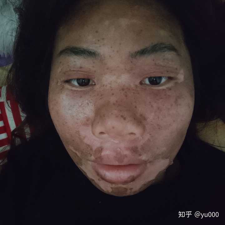 关于美容院的那种药水点痣点斑 有人说有效 有人说点了还不如以前 谁