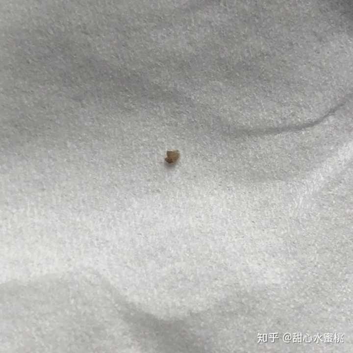 史上最大的黑头有多大?