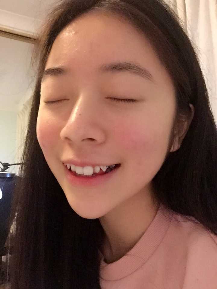 虎牙被拉进去一点点了 牙缝也开始有一点点了 9月份