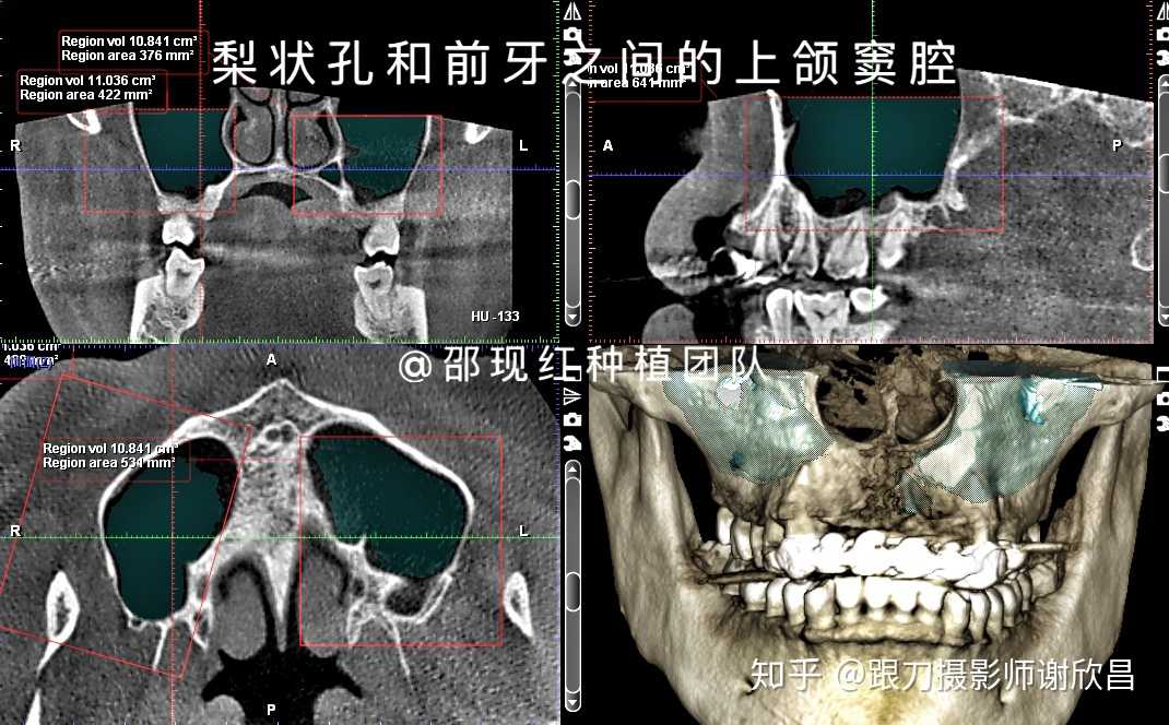 上颌窦腔,是4组鼻窦中的其中一组,处在上颌体内大约中心的位置