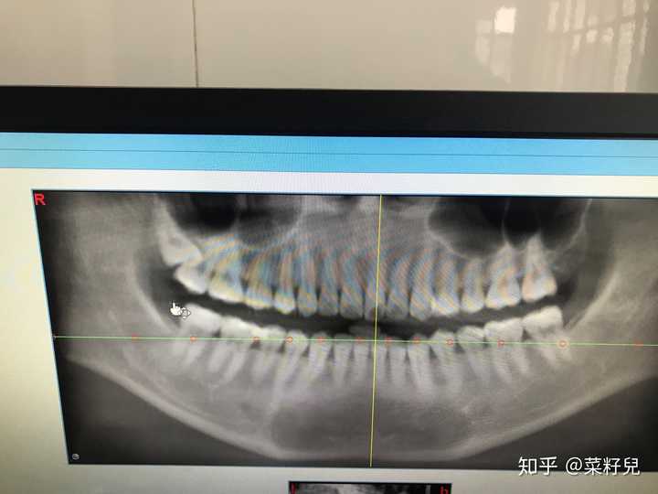 拔智齿和拔完智齿是怎样一种体验?