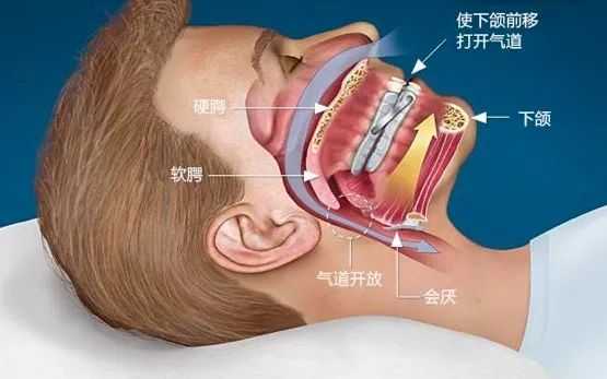 另外,口腔矫治器务必要到医院找到专业的口腔医