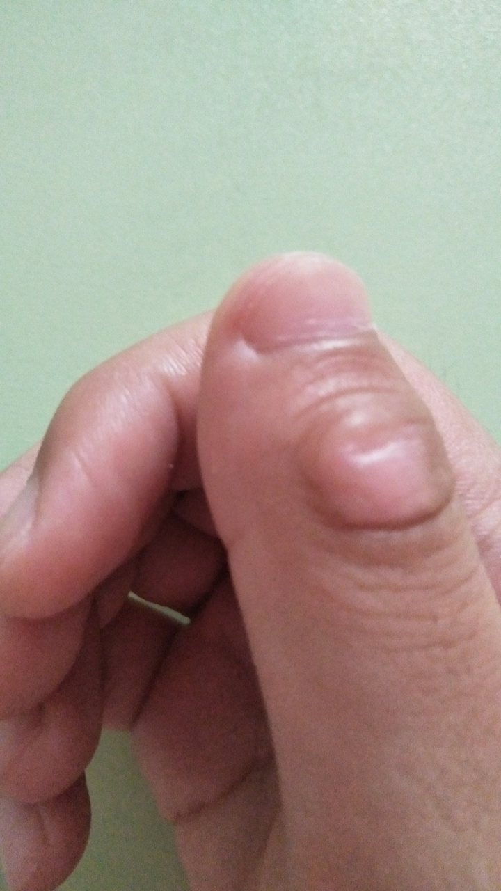 手指关节出皮肤变厚原来的纹路消失为什么会这样?