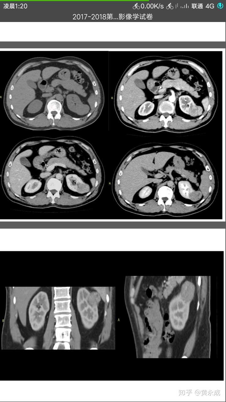 肾ct 有人会看么?