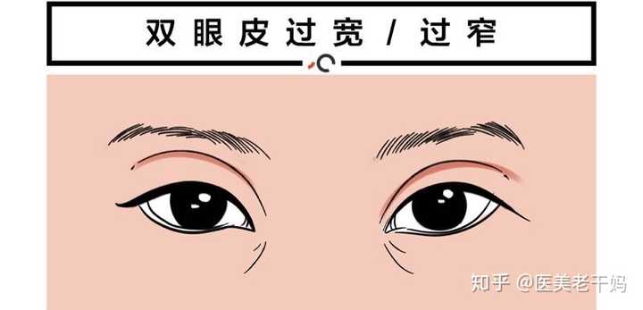 做完双眼皮后,虽然自然,但是眼皮过窄/过宽,时间久了,眼皮下垂,效果