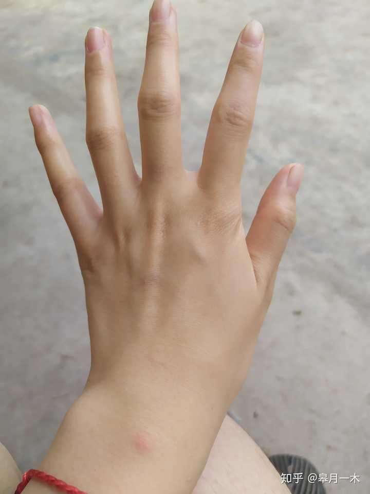 手上差不多好了,没好之前,蚊子是叠着咬的