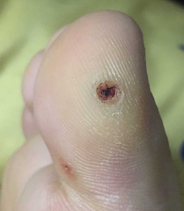 但是在北京去趟医院太麻烦,而且看好多人说巨疼网上看到有人说鸡眼根