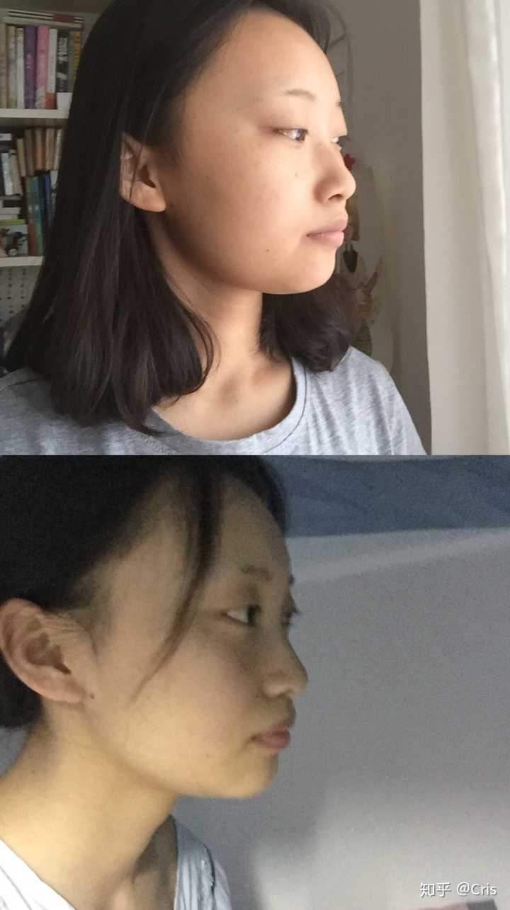 龅牙(上颌,双颌)前突是怎样的体验?