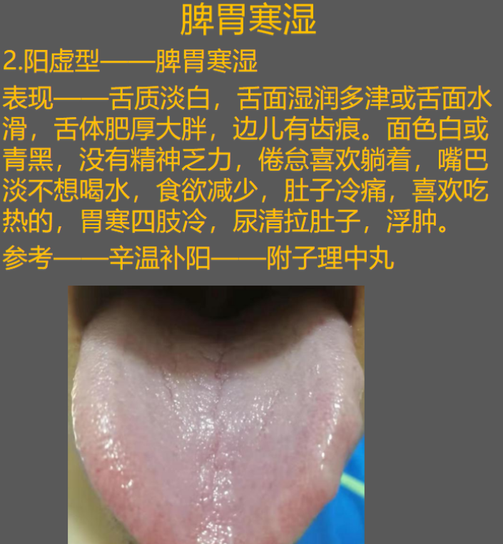 雷师兄健康 的想法: 胖大舌,齿痕舌属于脾虚,脾虚湿气