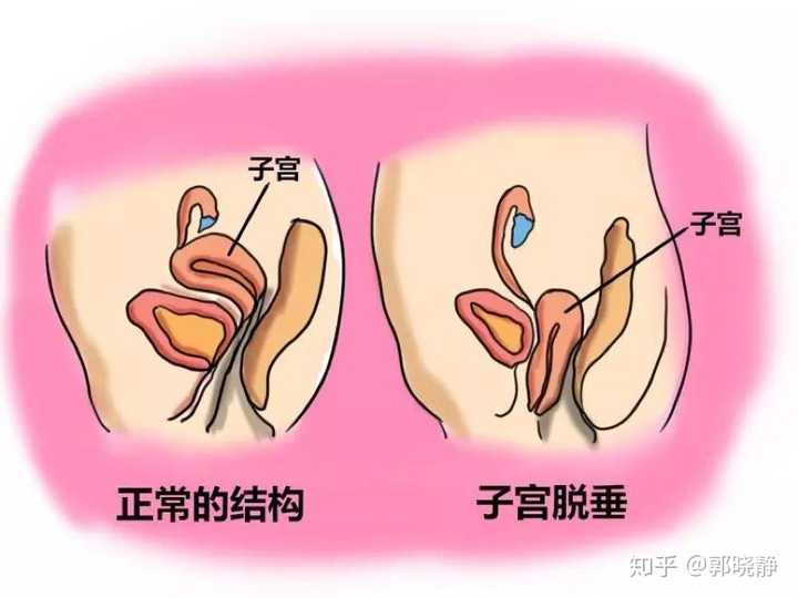 在分娩后盆底肌变得松驰没有弹性,使子宫随着体位变化而往下移,甚至