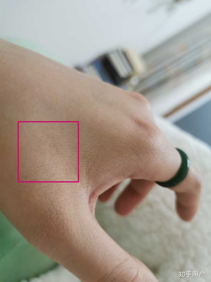宝宝头皮被烫会留疤吗?