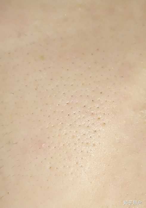 脸部毛周角化症怎么破?