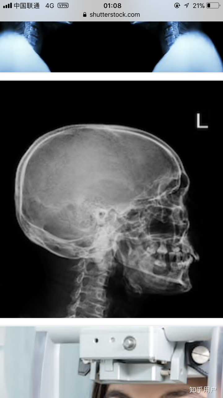 内行和专家的人用这种类型的x光来证明ab的头骨和其他正常人的不一样