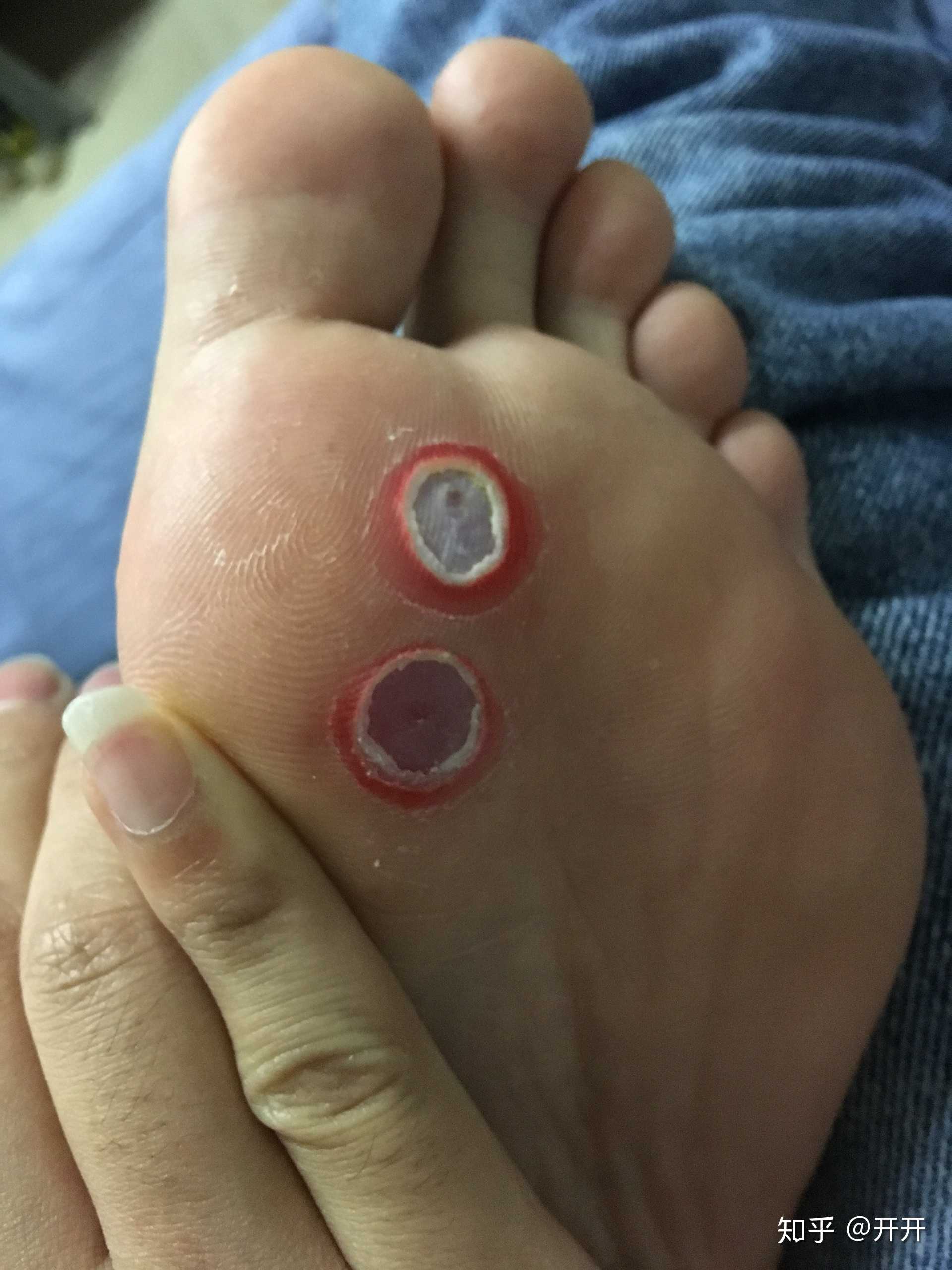 鸡眼贴使用过程