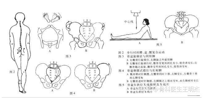 骨盆旋移综合征是指由于激素水平的改变,运动状态的变化或者突然施发