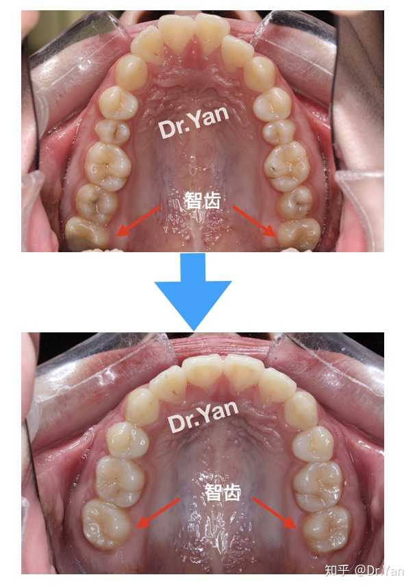 还有这样的情况像,下颌的6号牙(六龄牙)是嘴里最早长出来的,资格最老