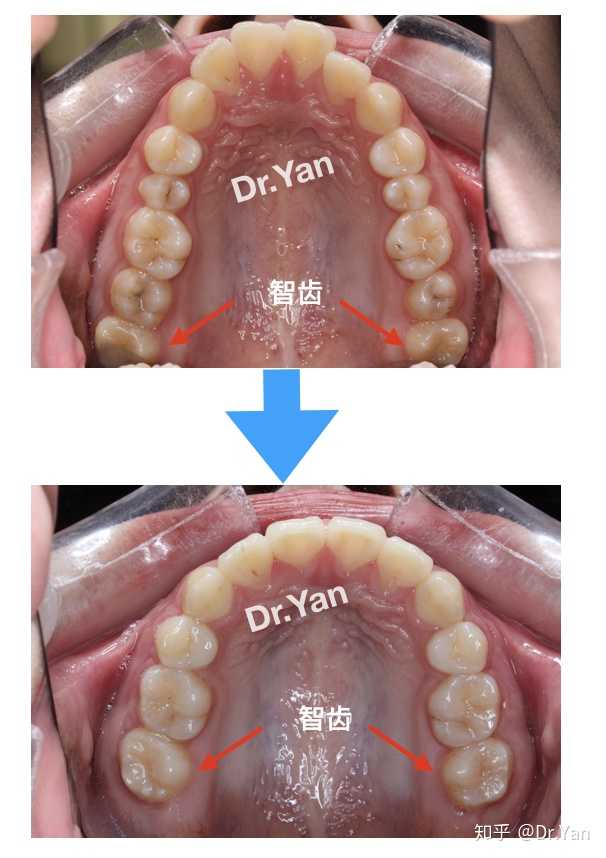 == 再比如这个患者,奈何7号牙太小智齿却很正常,最后拔了7留了更好的