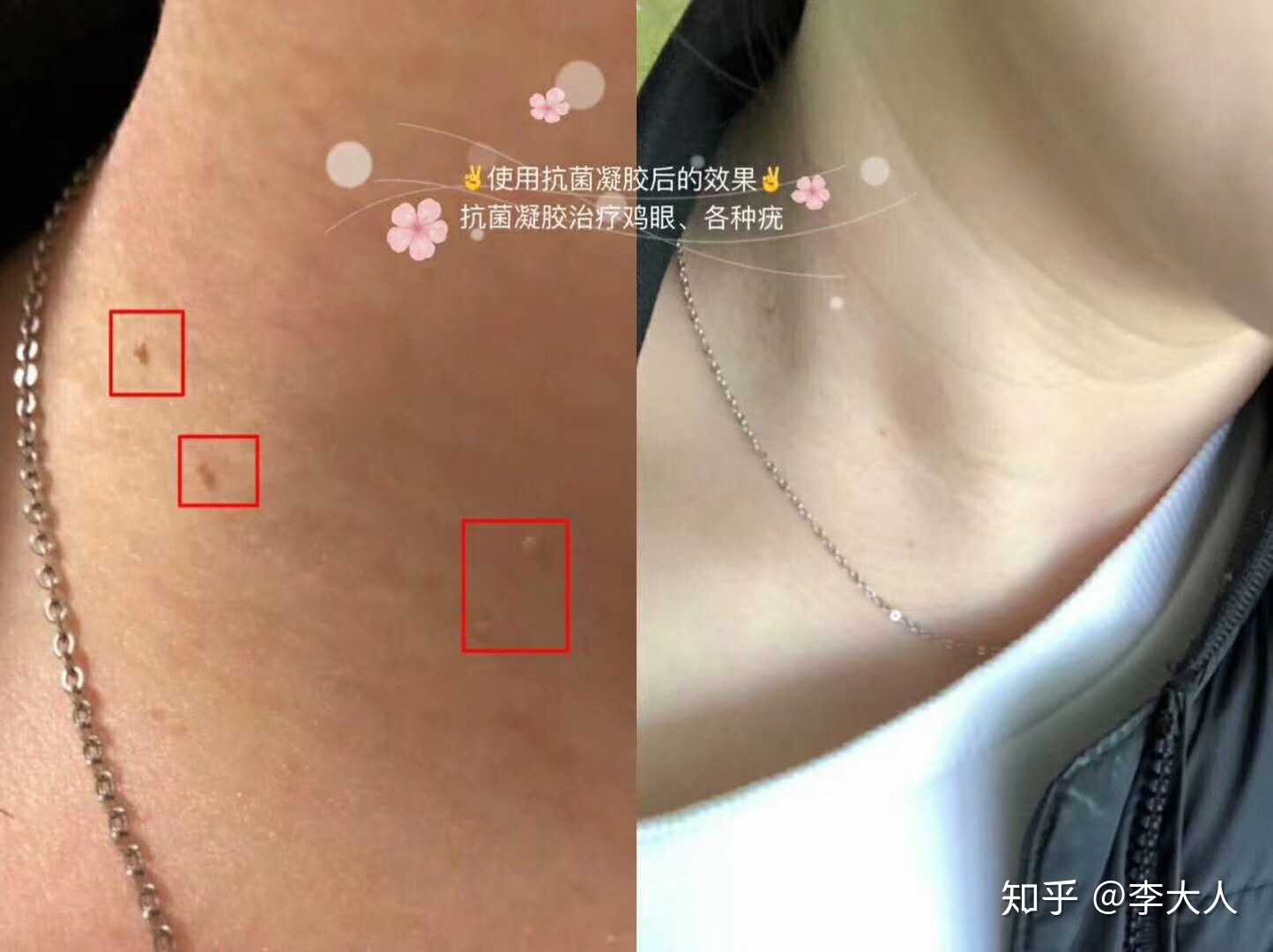 丝状疣～～病毒引起,不建议激光冷冻,因… - 知乎
