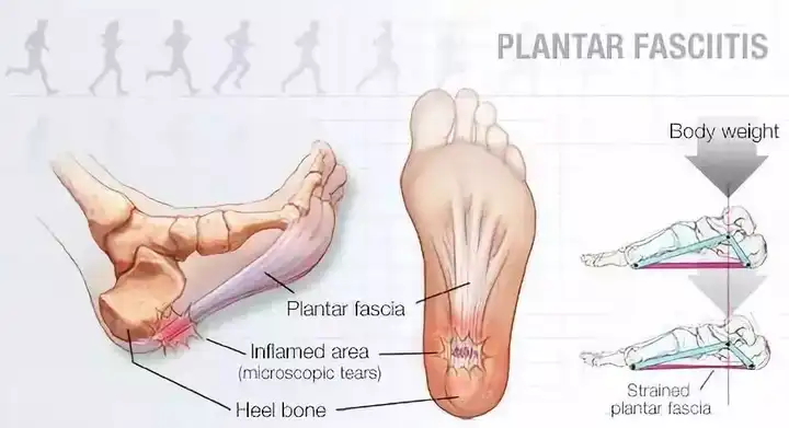 天天跑五公里,脚后跟痛筋膜炎,在不影响跑步情况下消炎的办法?
