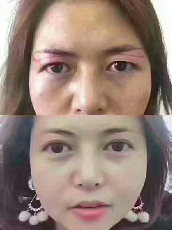 上眼皮很松,有点耷拉下来,显得不精神,以前不是这样的