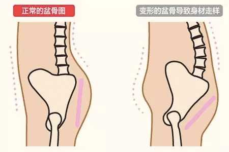 骨盆前倾导致走路不自然,怎么恢复正常?