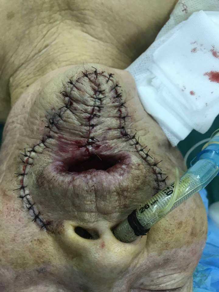 这是一个下唇癌的病人86岁