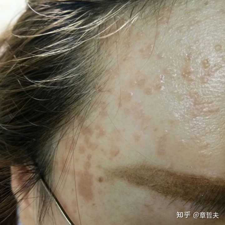 扁平疣会自然脱落吗?在脸上,面积不大?