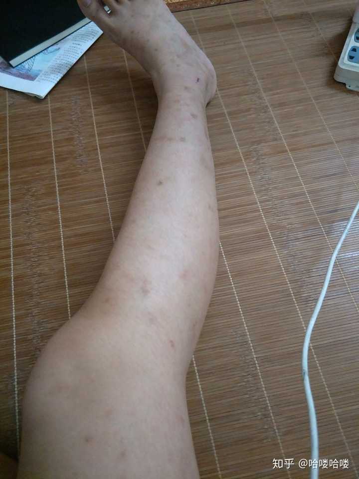 被蚊子咬了留下的疤怎么去除?