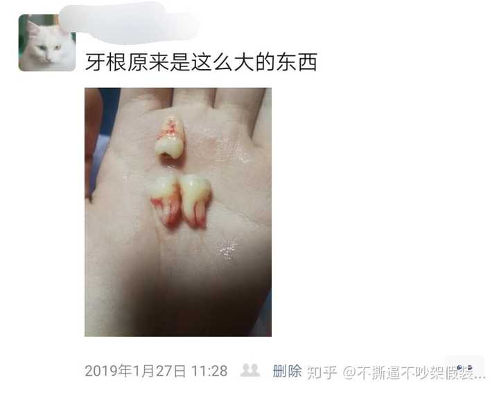 为什么医生不让我一次性把智齿都拔了?