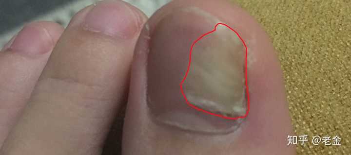 这是真菌感染引起的灰指甲(甲菌)症状,恢复的关键在于除菌.