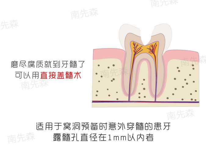 其实还有三种情况, 间接盖髓术,直接盖髓术或 活髓切断术(医生为了