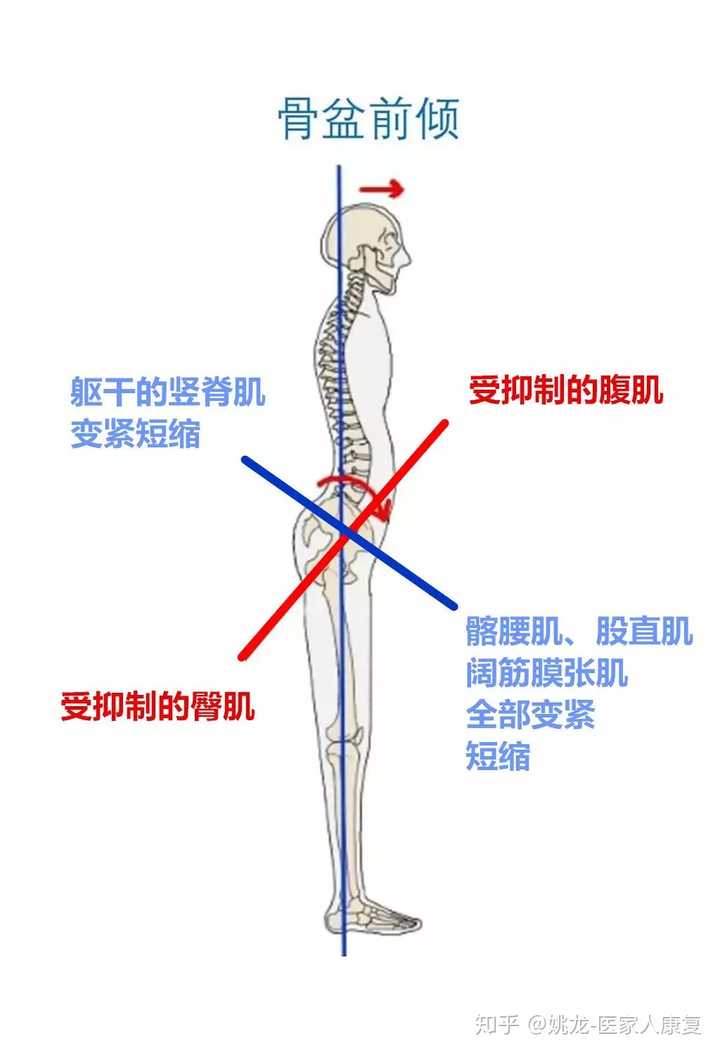 如何改善骨盆前倾?