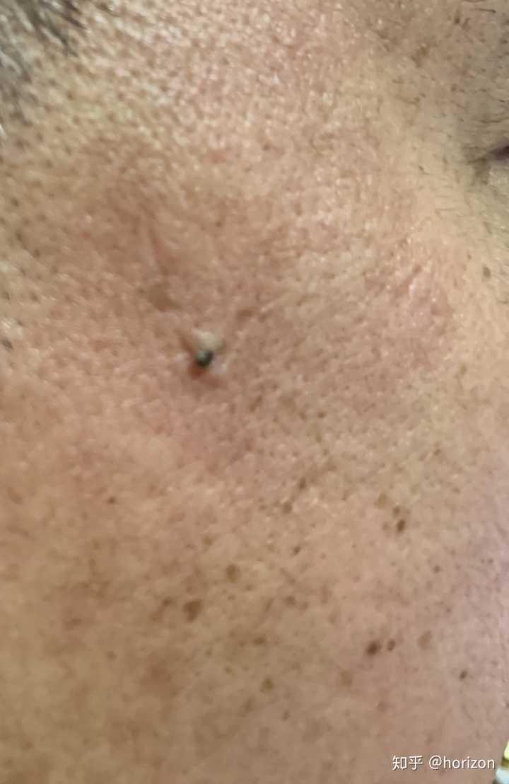 史上最大的黑头有多大?
