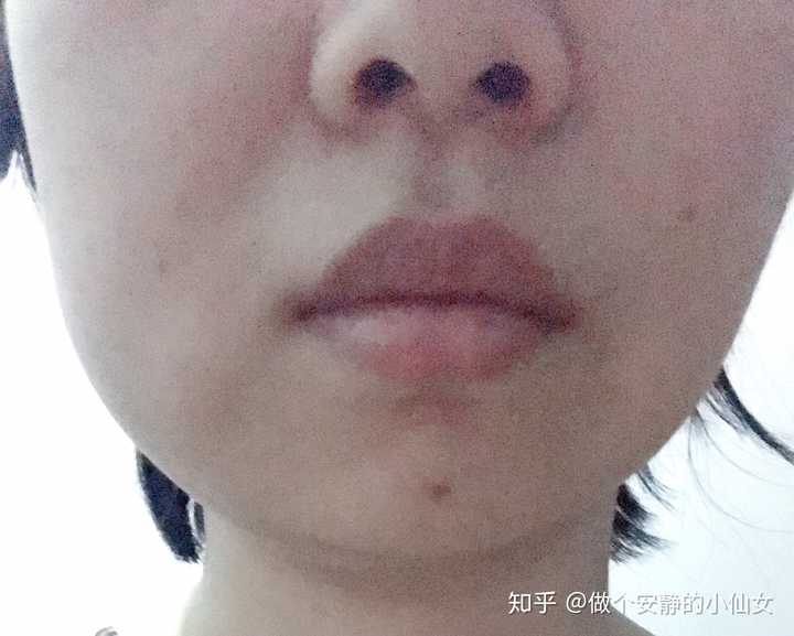 拔水平阻生智齿,术后第二天脸肿了,请问几天能消肿?