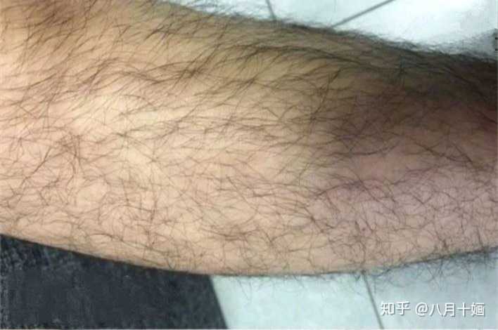 腿毛多的男生夏天怎么办?