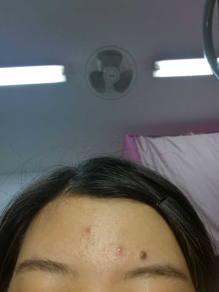 手术切痣是一种怎样的体验?