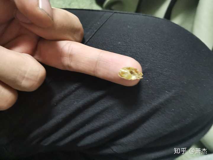 耳屎能大到什么程度?