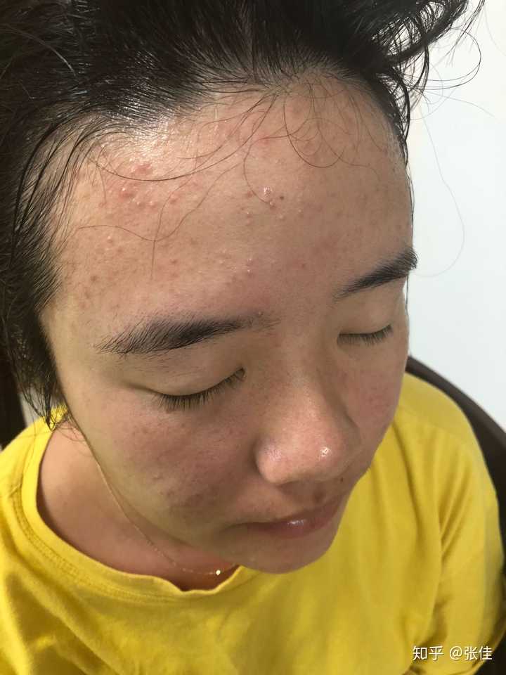 怎样正确的用水杨酸去闭口?