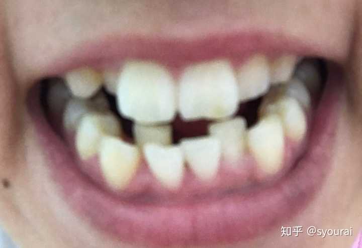 拍几张牙齿的照片,记录一下没矫正之前的牙齿有多不齐