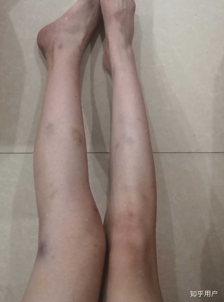 玩滑板对腿有影响吗