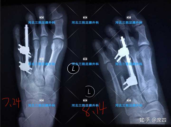 这个手术一定要和医生做好随访,以免跖骨延长过度或延长不足,影响手术