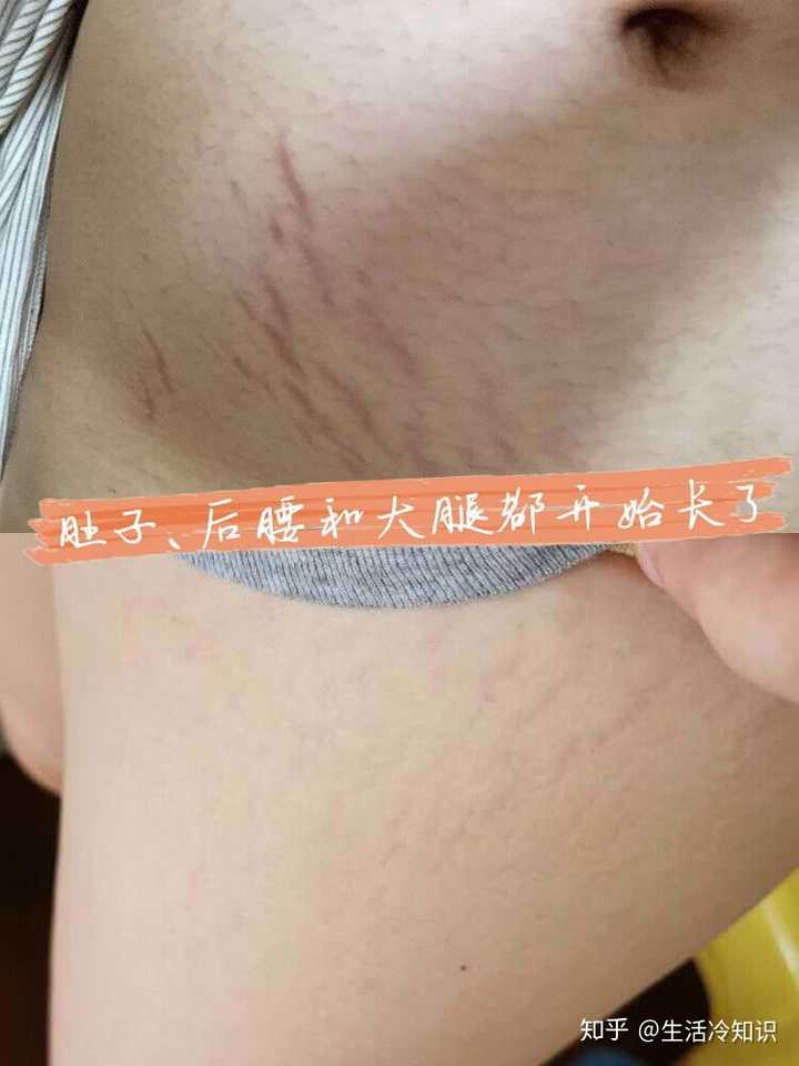 妊娠纹怎么淡化?