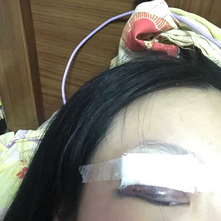 第二天我就试着吧纱布揭开 忍不住想看看自己的眼睛 然后着实把我下了