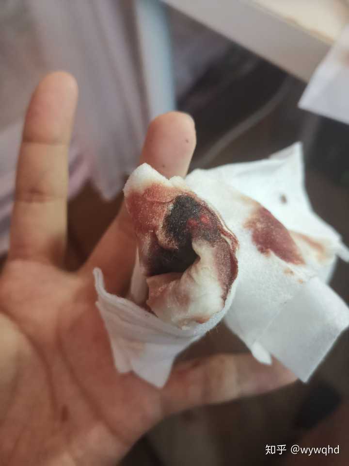 手指被割掉一块肉是什么体验?