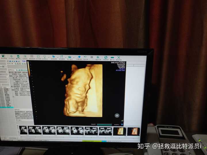 你第一次看到宝宝的四维彩超照片,是什么感觉?