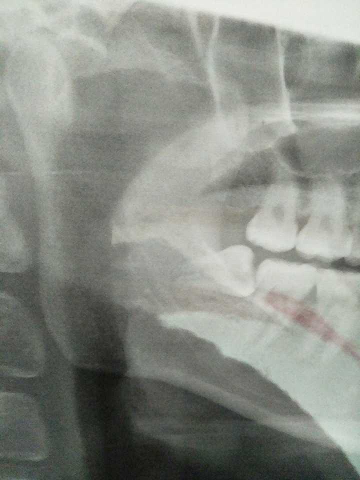 拔智齿是种怎样的体验?