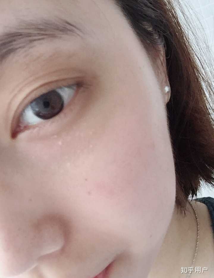 得了甲亢一个眼睛突出突,能回去吗?