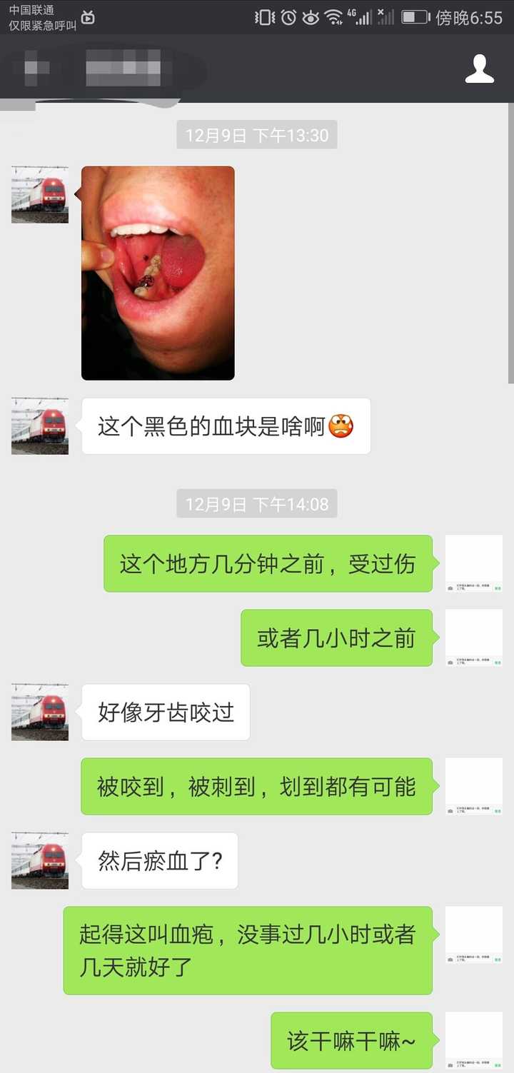 嘴巴里面腮处起了个黑色血泡是怎么回事?