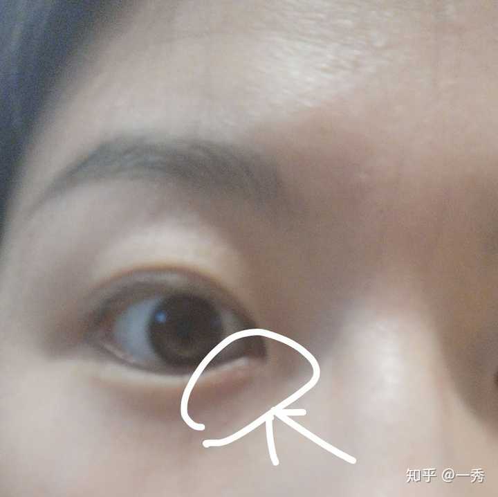 有起过内麦粒肿的吗?你们都是怎么治好的呢?