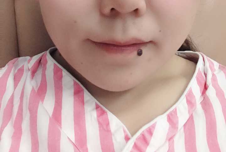 请问下手术去痣会留疤吗?会病变吗